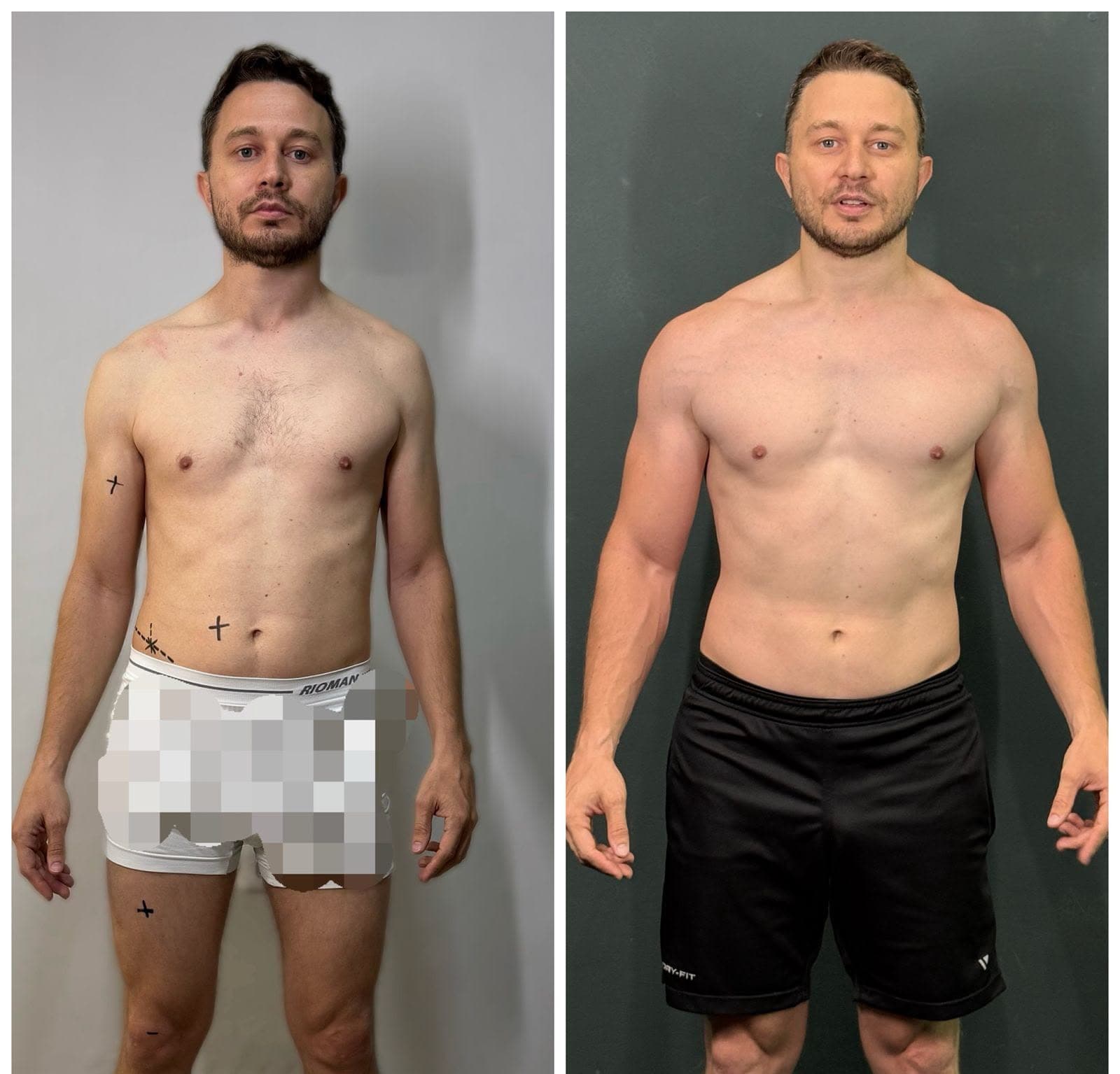 Duas fotos do mesmo paciente, de frente, em dois momentos do acompanhamento nutricional (8 de 9)